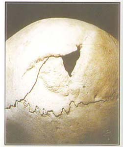 The skull of teenage girl that had been operated for Hydrocephalisis disease